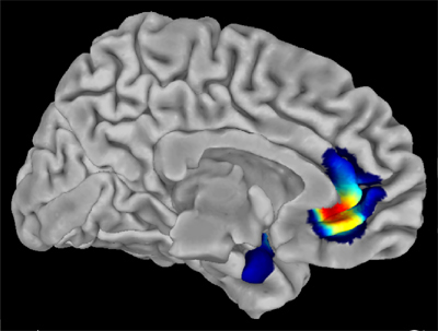 grey matter volume differences